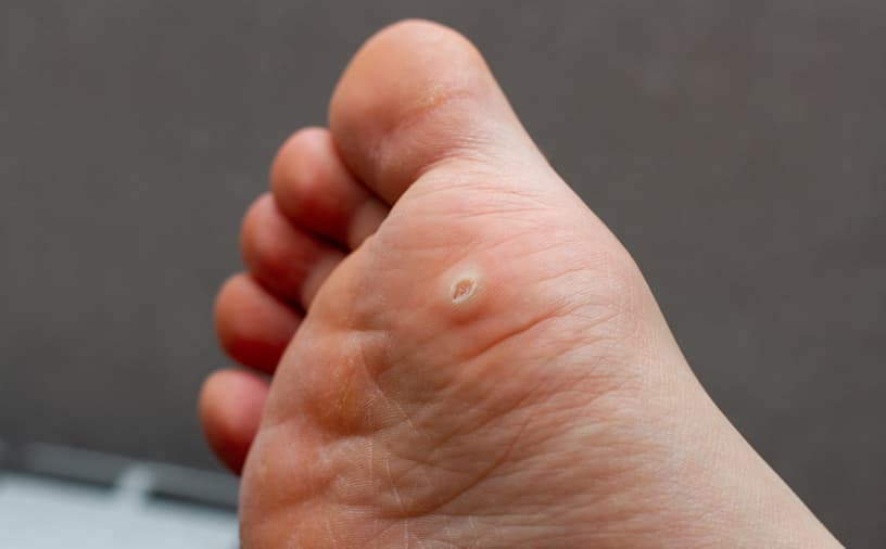 La verruga plantar no desaparece sola